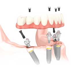 Implant Supported Overdenture 4 Implants