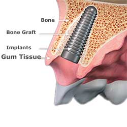 bone graft