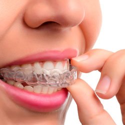 adult braces