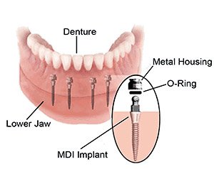 mini implant