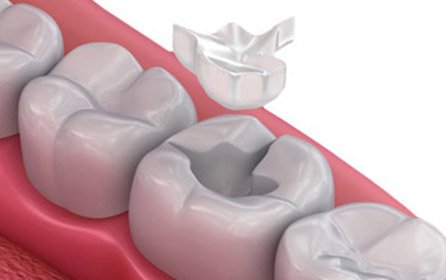 composite white fillings