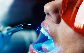laser whitening
